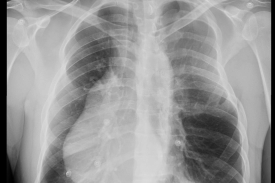 Diagnosis of Poland syndrome 2026