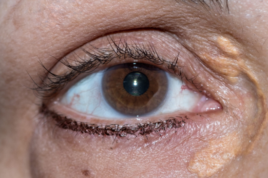 Xanthelasma: What is it? 2024