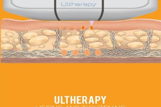 Ultherapy Turkey 