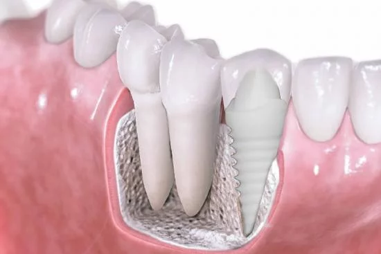 Implant et facette dentaire en zircone 
