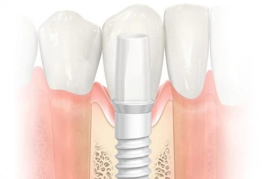 Implant et facette dentaire en zircone 